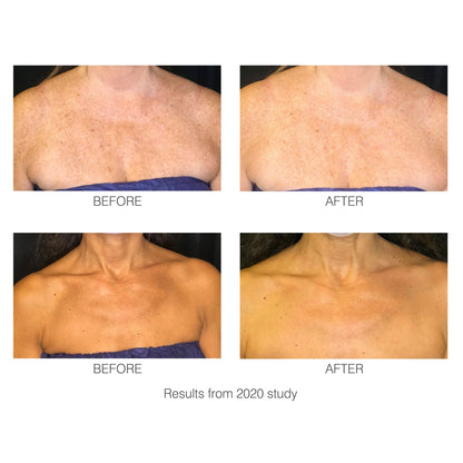 2/2 - 2020 Study - Before and after images showing how the decoLITE LED light treatment soft-fit mask has improved the look of wrinkles and pigmentation.